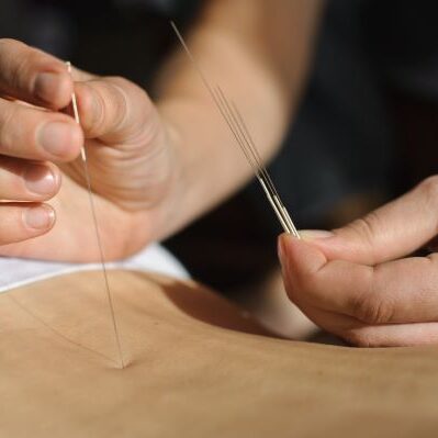 Acupuncture needle being gently inserted into the lower back to relieve pain