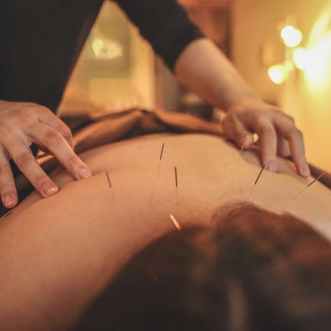 Close-up of acupuncture needles placed on a patient’s back for pain relief therapy
